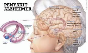 Menghindari Penyakit Alzheimer: Strategi untuk Kesehatan Otak
